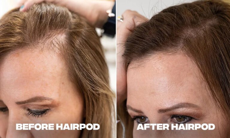 before-after-hair-shedding-woman1